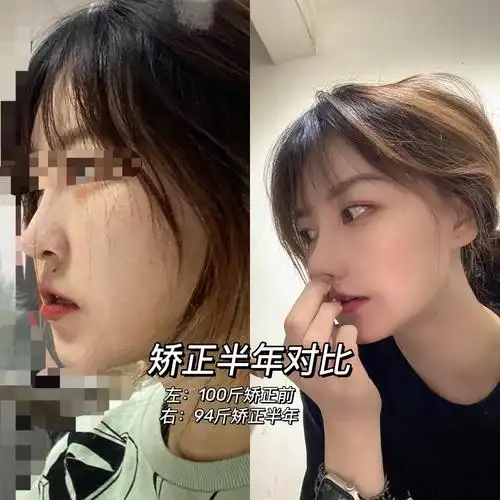 矫正半年对比效果图