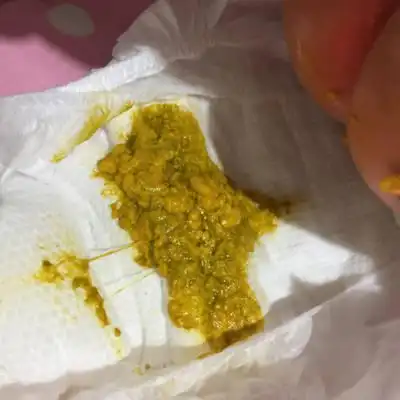 怎样知道宝宝是不是消化不良,宝宝的大便这样正常吗?