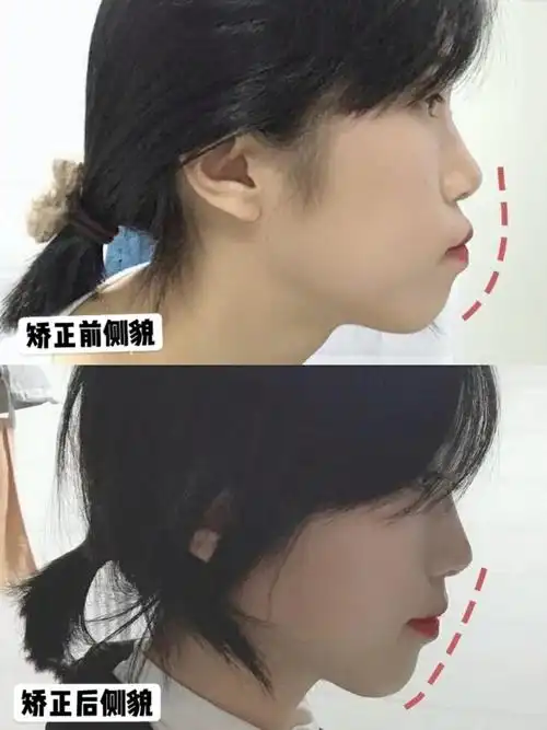 小姐姐牙齿内收5mm后成为精致小女神967415矫正坐标_圈子-新氧