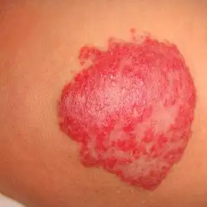 比如草莓状血管瘤红色突出周围正常皮肤,海绵状血管瘤会在皮下隆起