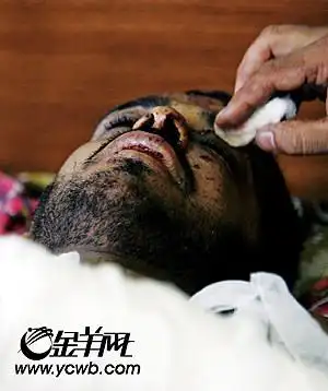 爆炸中的受伤者.