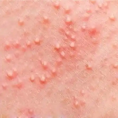 今天主要来讲讲怎么对付痱子?湿疹和痱子咋区分?