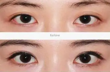 郑州做开眼角手术会影响视力吗,为什么