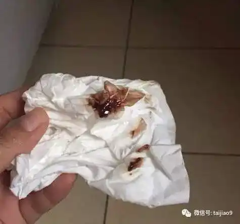 孕期分泌物如果出现这种异常要当心,可能是胎儿的求救信号