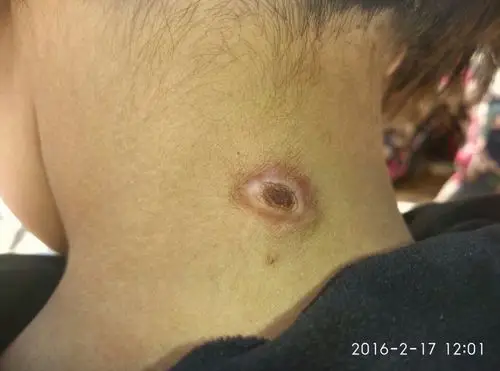 我侄女今年7岁了,她的脖子后面长了一个很大的白色