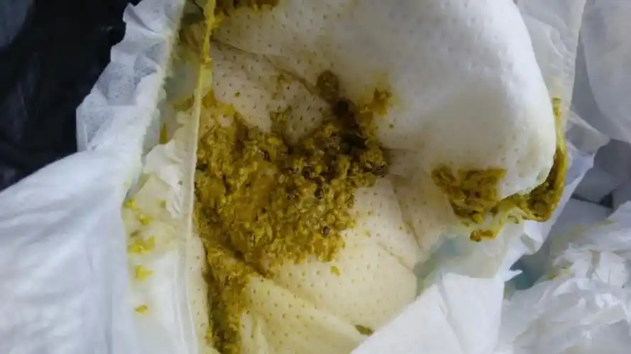 我宝宝拉肚子,拉出的便便是这样,是消化不良还是受凉引起的?