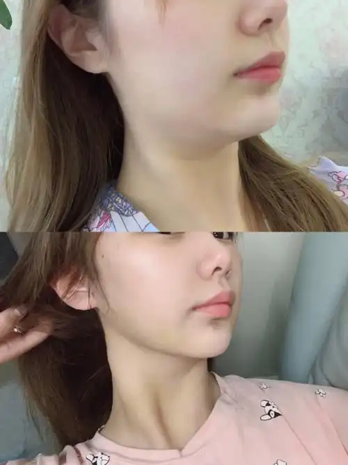 肉毒素也能提升下颌缘?这是什么原理呢?