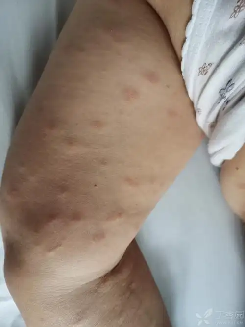 各位大神看看这些照片是什么皮肤病,谢谢 [病例帖]