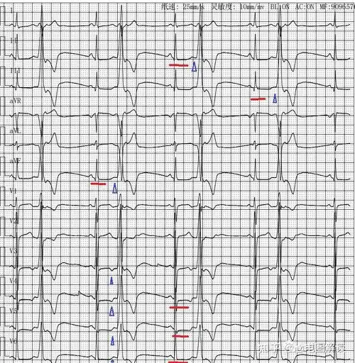 室性早搏二联律判断及对stt判断的影响