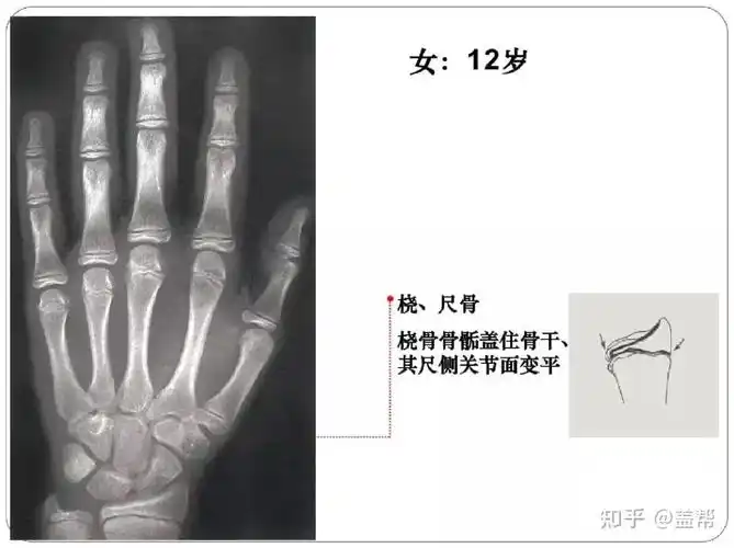 骨龄几岁还能长高吗女孩篇