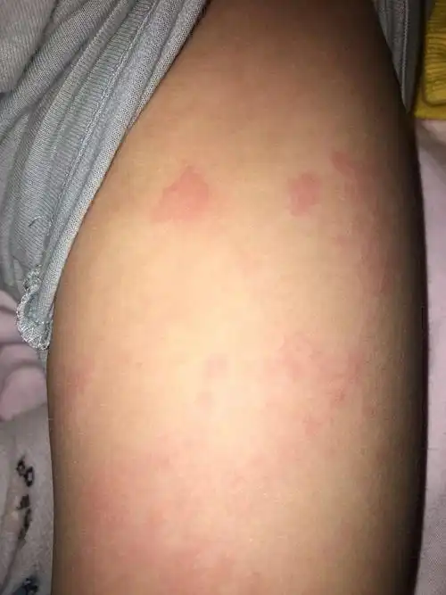 宝宝全身发风疹块了,原因不只是过敏噢-黄剑峰副主任医师-爱问医生