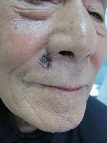 皮肤肿瘤之二基底细胞癌