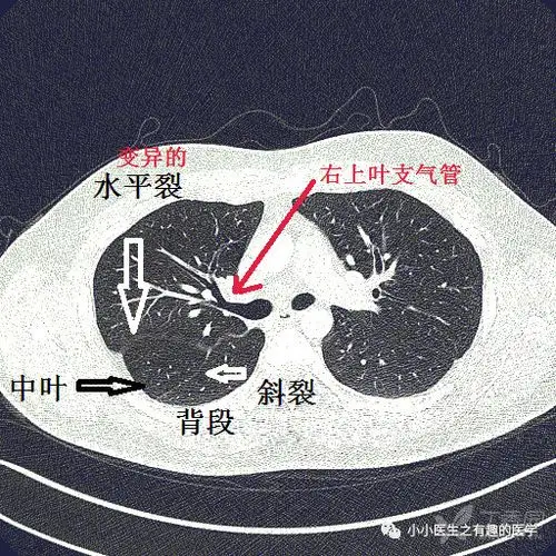 ct解剖:这个病灶在中叶?99%的人会看错,秘诀是什么