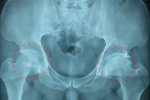 增高治疗前x光片:患者左侧股骨头塌陷,碎裂,变形,股骨颈骨皮质不连