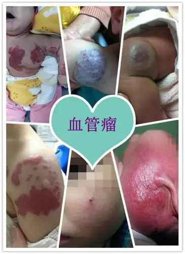 婴幼儿为什么会长血管瘤_血管瘤_血管瘤发病原因 - 好大夫在线