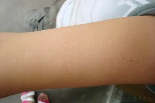 11:18 编辑  [病例讨论]看图诊断16…特发性点状白斑字体大小:tt附件