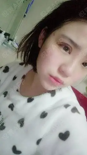 【长沙南湖整形医疗美容医院】【眼综合】