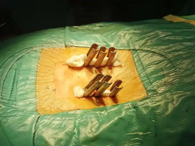 刘林主任团队成功开展endo-tlif治疗腰椎滑脱症 写美篇手术方案  考虑