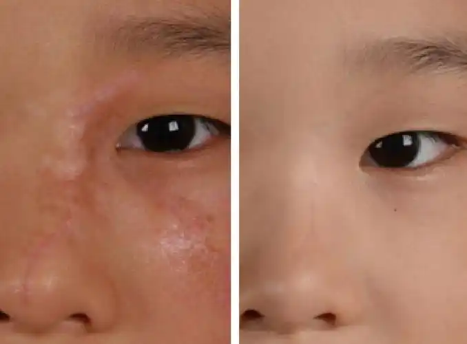 疤痕祛疤的方法可以根据不同的.@单音变美攻略的动态