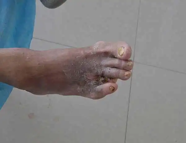 糖尿病并发症烂脚降血糖后伤口还是不好该怎么治疗_袁敏琴糖足中心