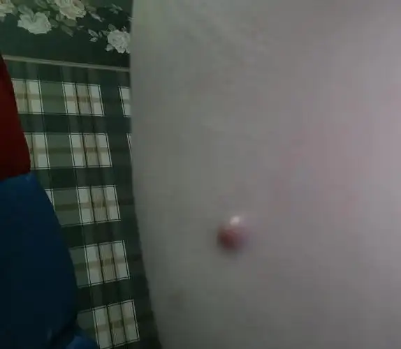 后腰长了个痘痘.是不是粉瘤呀?