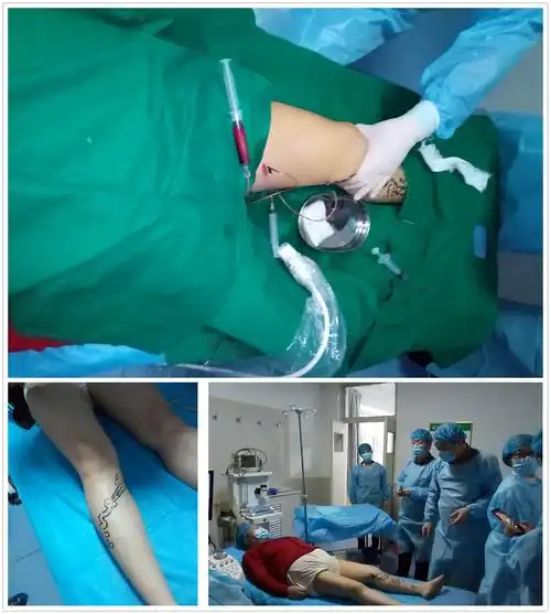 聚桂醇注射液治疗下肢静脉曲张手把手教学