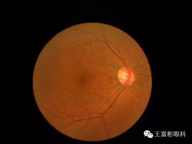 "无视中央"的白化病眼病