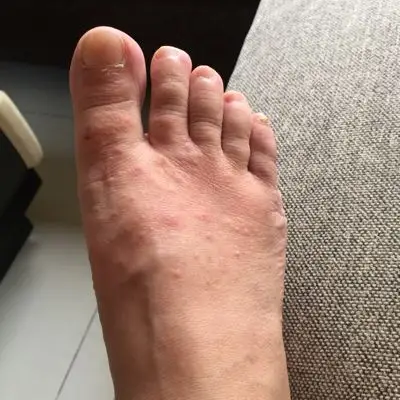 两天前我的两只脚背突然就长了好多这样的痘痘,还特别痒,越挠越痒