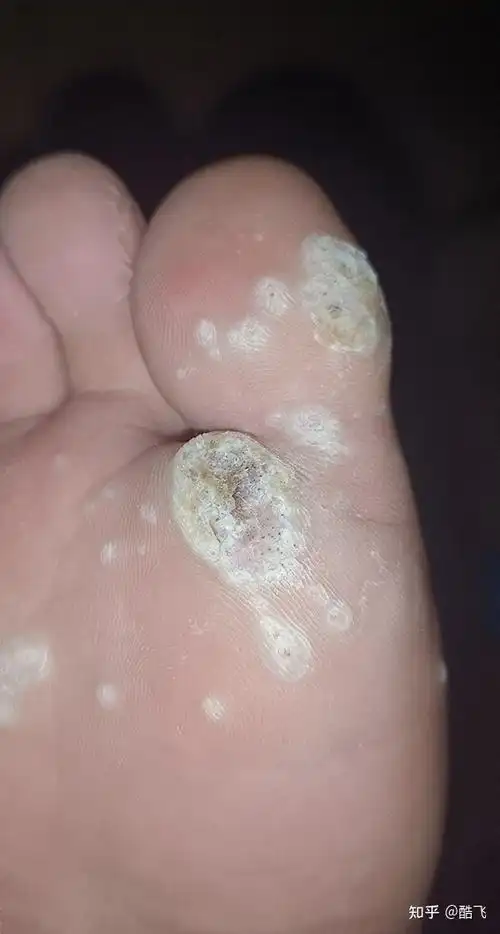 多发性跖疣无痛治好了