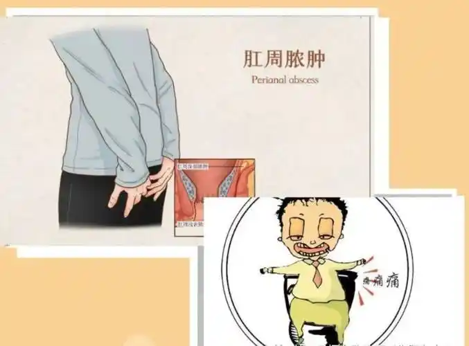 肛周脓肿发作可以不手术,保守治疗吗?_病人_医生_肛瘘