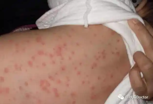 左甲状腺素钠(优甲乐)致严重过敏反应一例(附脱敏疗法)