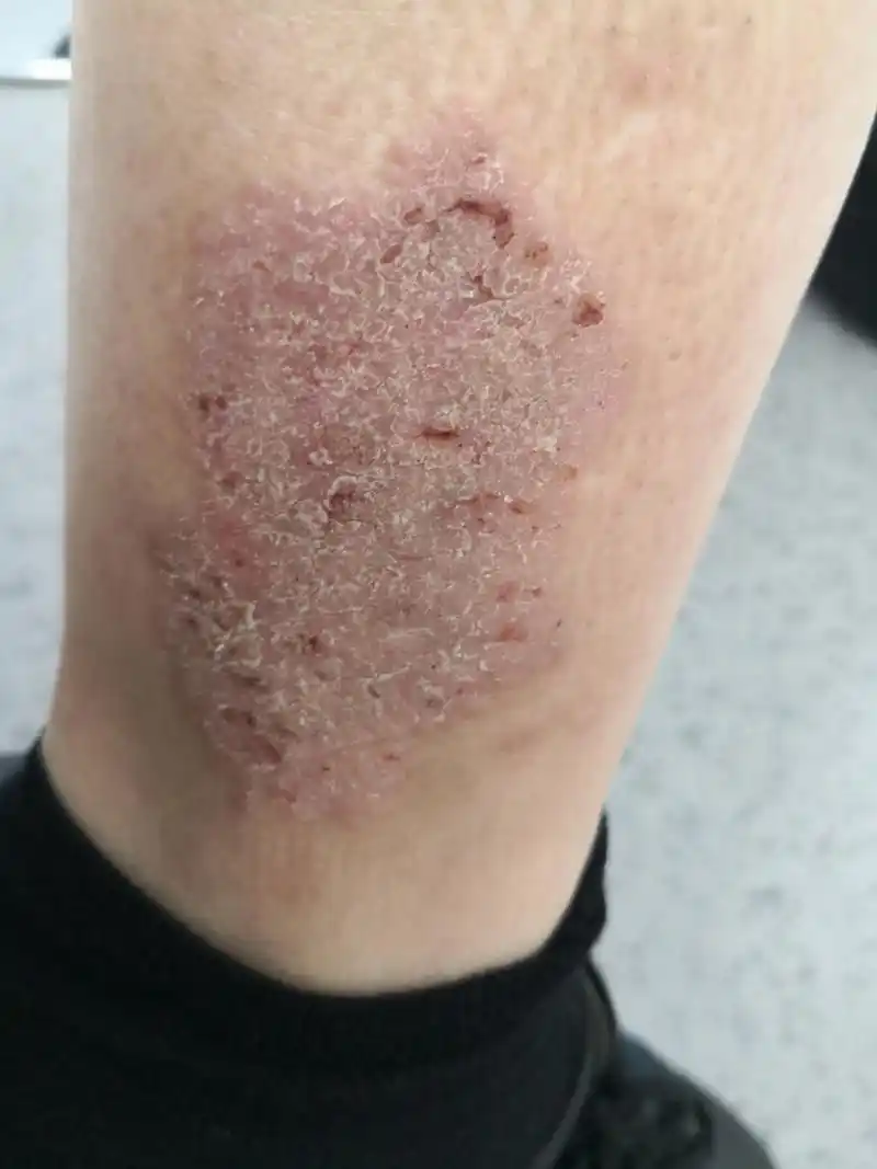 一侧小腿斑块状湿疹症状.#湿疹