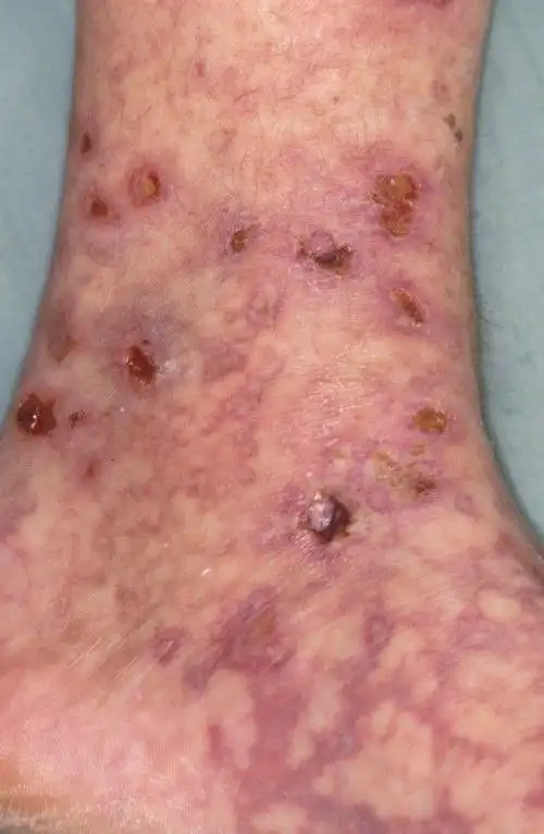 网状青斑和青斑性血管炎