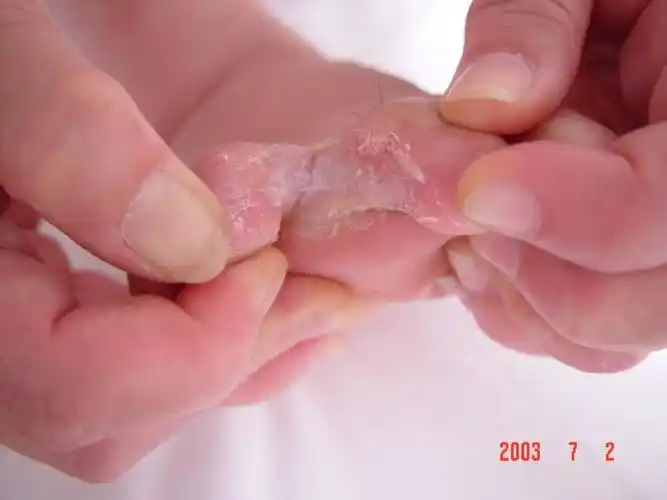 夏季癣病高发如何科学防治