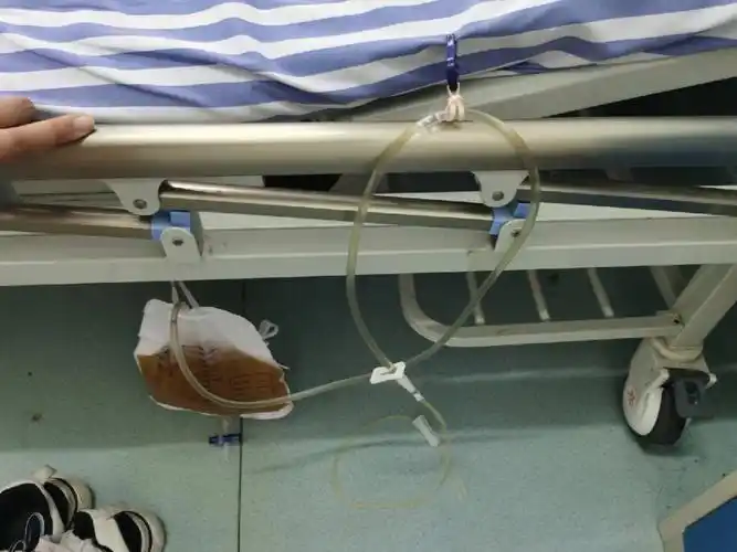 住院了,腹水穿刺