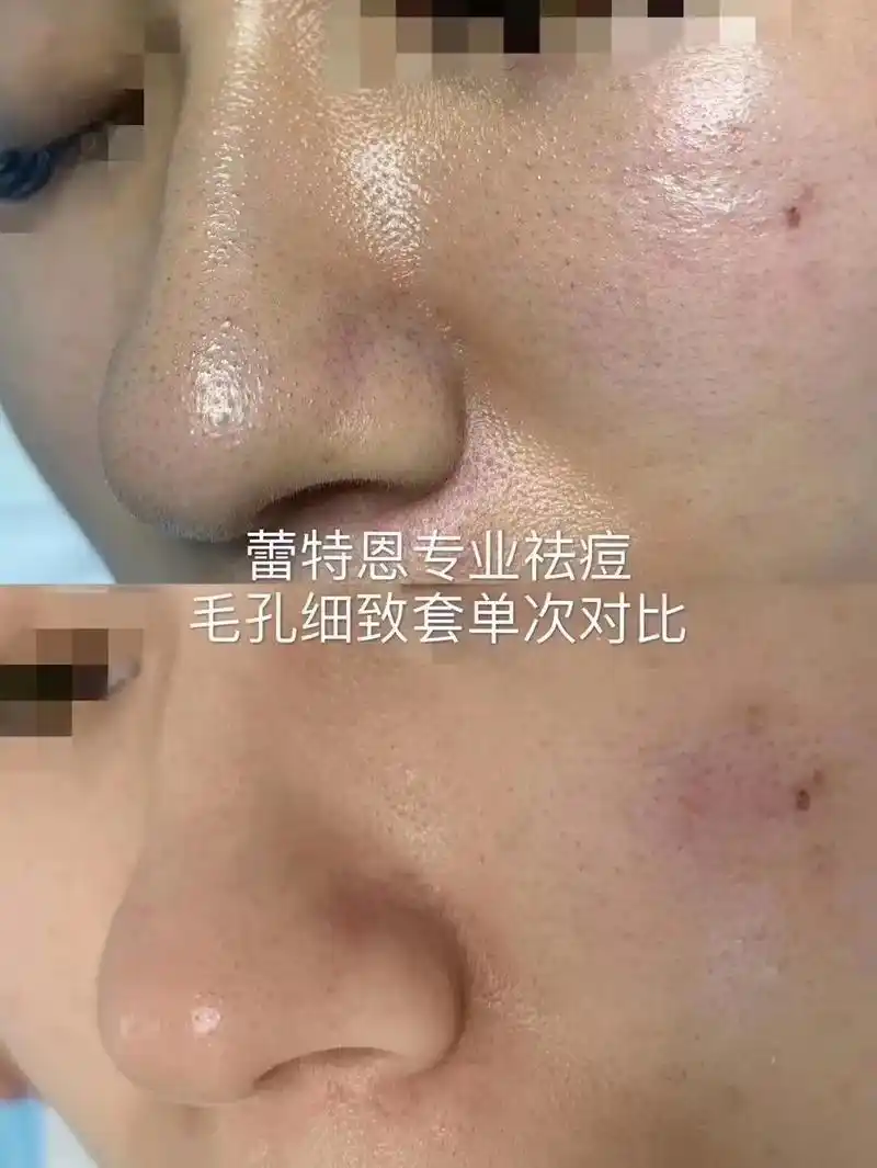 96#为什么会长黑头?#痘痘黑头粉刺拜拜 # - 抖音