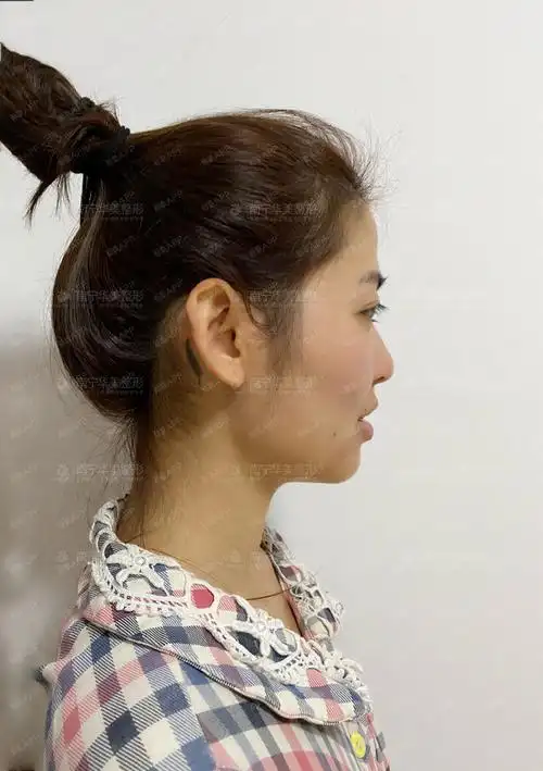 鼻头圆钝,山根低矮,鼻翼宽,鼻小柱较短,求美者诉求_圈子-新氧美容整形