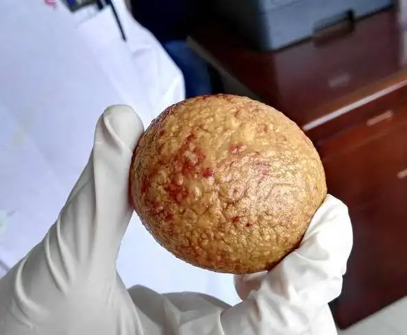 此前,中国深圳一男子膀胱中拿出来的结石也大的吓人,比拳头还大,几乎