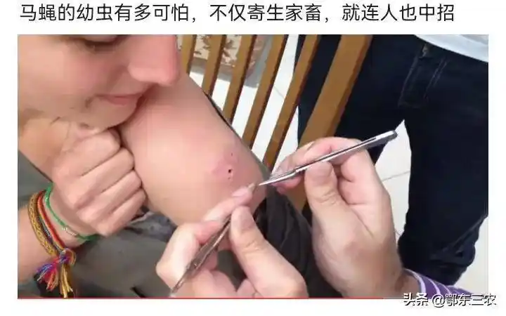 农村马蝇能寄生在人身上小姑娘身上寄生5只幼虫太痛苦了