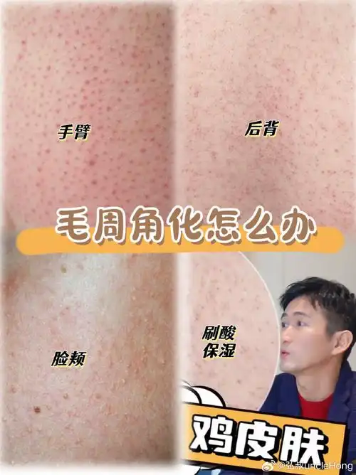 妆点东方##毛周角化怎么办##护肤跟练团