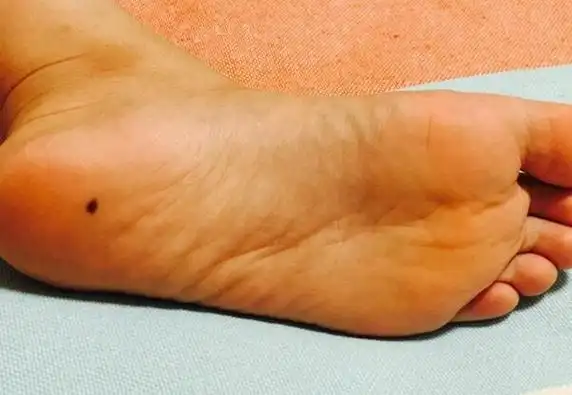 脚底有痣女人好不好?长在脚底意味贵不可言,娶到就是赚到