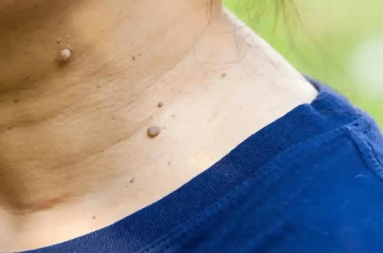 无论男女身上长瘊子就是hpv携带者医生提醒看到躲远点