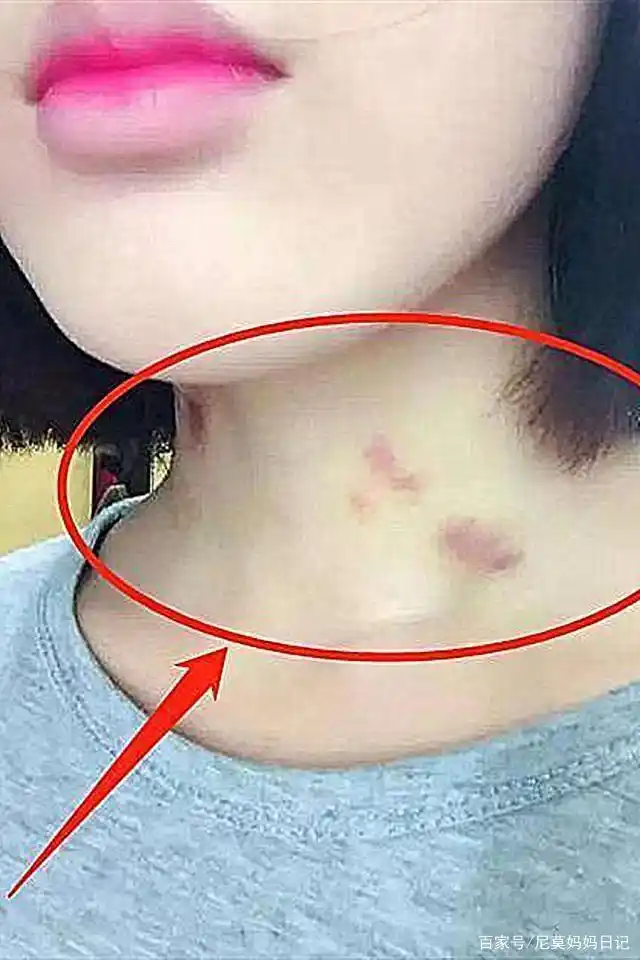 12岁女儿脖子上出现"草莓吻痕",父母追问下,孩子的话引人反思