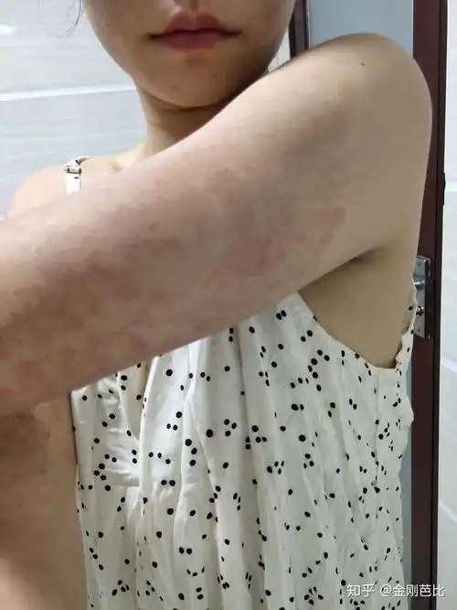 得了多形性红斑,怎么才能痊愈啊?要忌什么吗? - 知乎