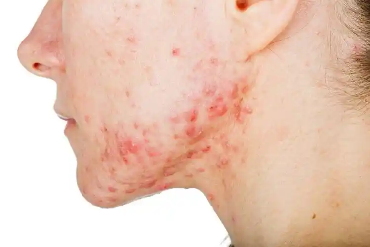 痤疮是一种好发于青春期并主要累及毛囊皮脂腺单位的慢性炎症性皮肤病