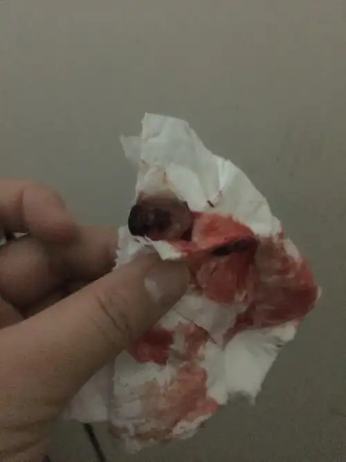 药流,六个小时排出孕囊(图片血腥,介意勿入)