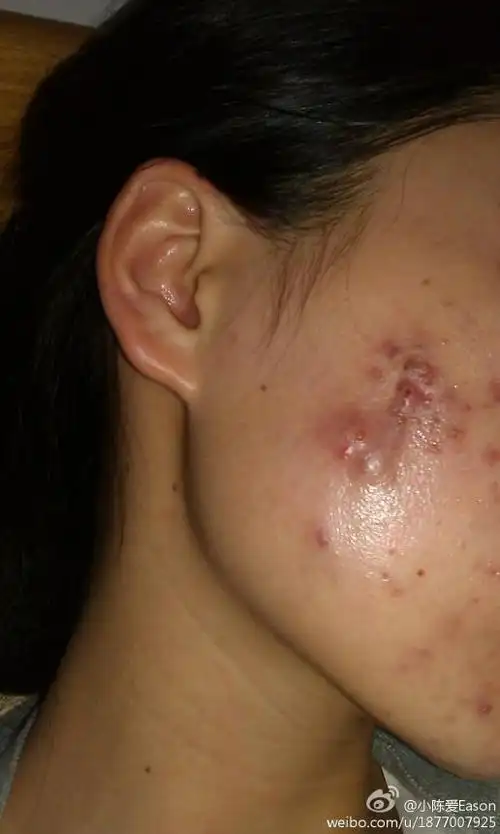 我23岁, 脸上长这种脓包型痤疮有三个月了,触碰到会疼,有去皮肤