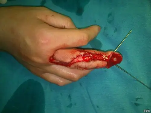 右中指近节背侧逆行岛状筋膜皮瓣修复手指创面