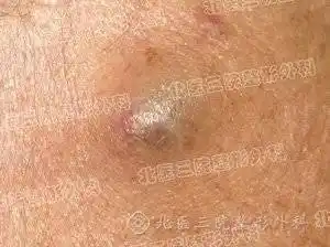 脸上长粉瘤怎么去掉不留疤?_皮脂腺_美容_肿物