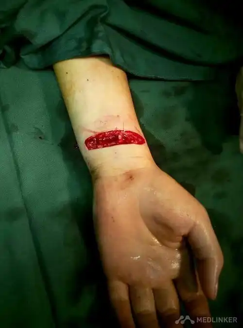 左腕部腕横纹近端见多处刀割伤痕,创口内可见肌腱断端外露,伤口呈活动